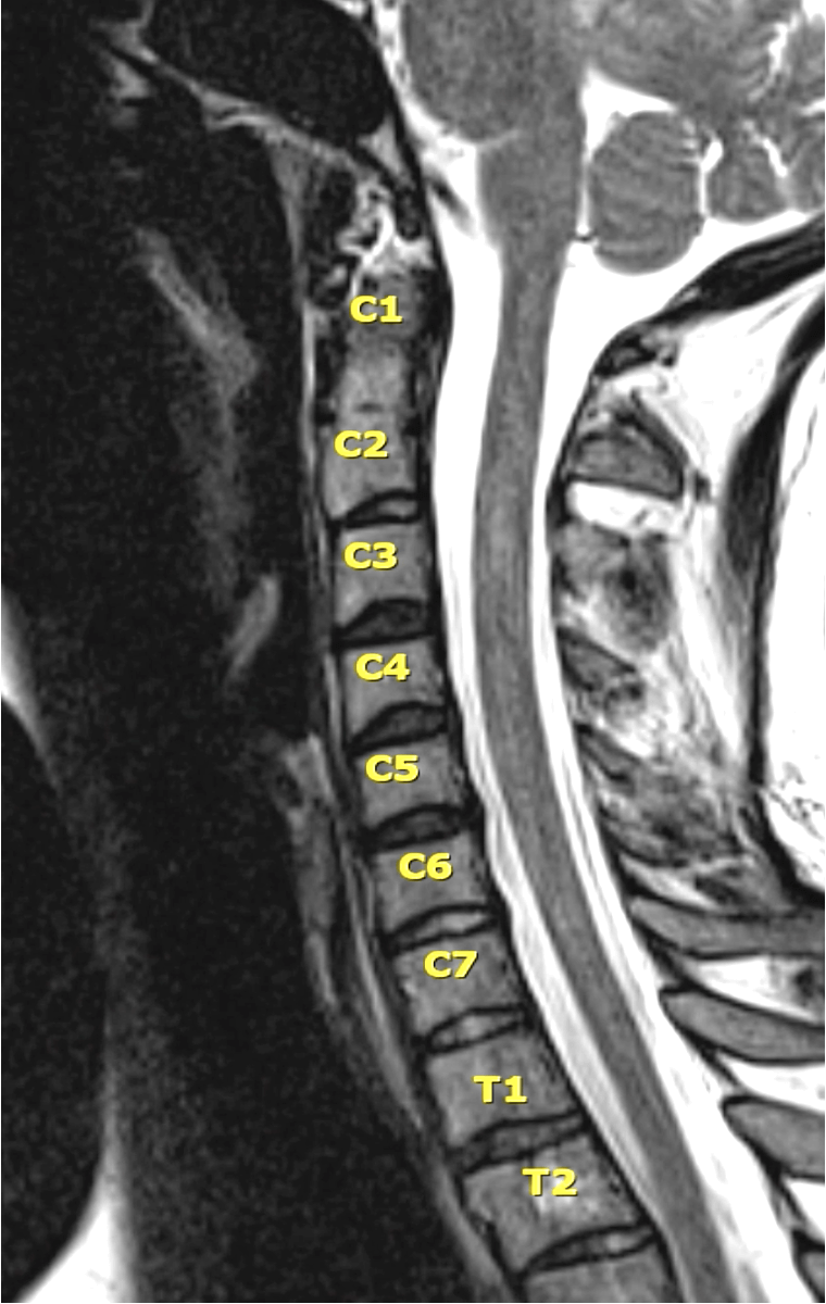 tiny spine image