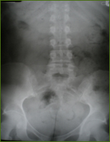 Chiropractor Atlanta Lumbar Scoliosis